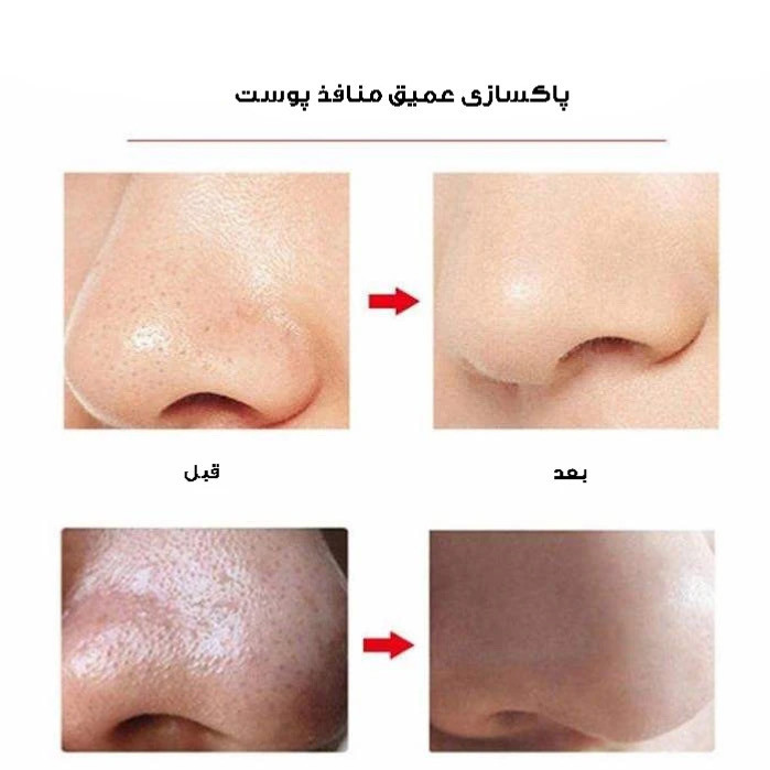 میکرودرم گلویش استایل مدل HY803 به همراه ست پاکسازی صورت بسته 5 عددی